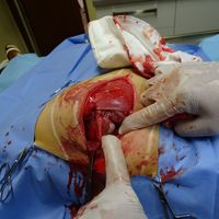 Operácia bedrového kĺbu, antilopa bongo, fixácia hlavice femuru